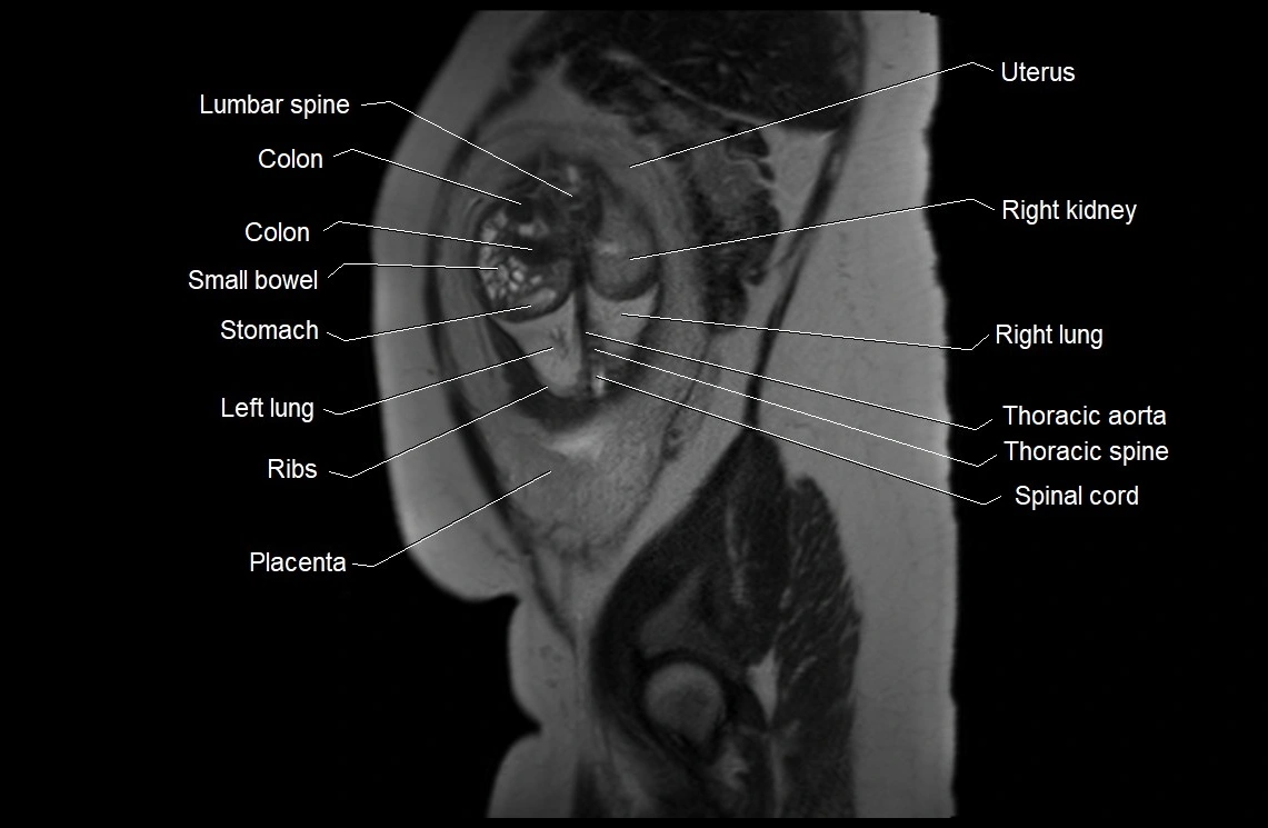 MRI fetal anatomy sagittal image 7.webp